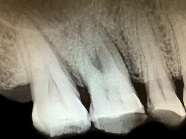 Jemné Ladění Zubů Ray Výsledek Monitoru Prezentující Zdravý Kořen Zřícenina — Stock fotografie