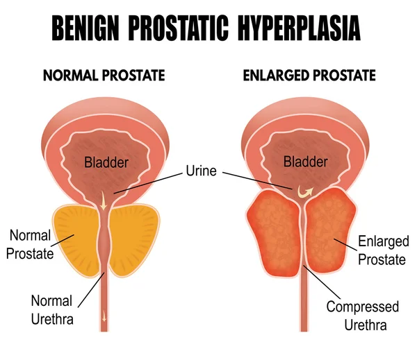 Hiperplasia benigna da próstata —  Vetores de Stock