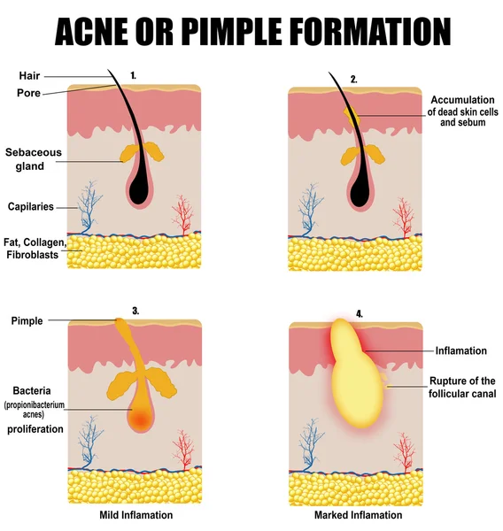 Formation d'acné ou de bouton cutané — Image vectorielle