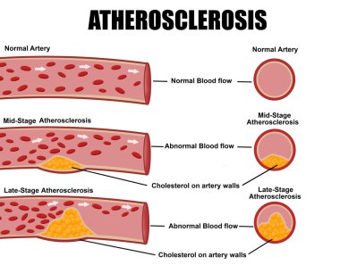 Detailed Atherosclerosis stages clipart