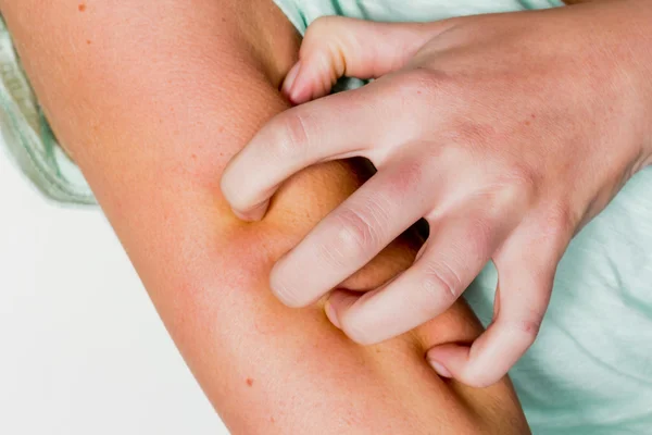 Vrouw jeukende huid — Stockfoto