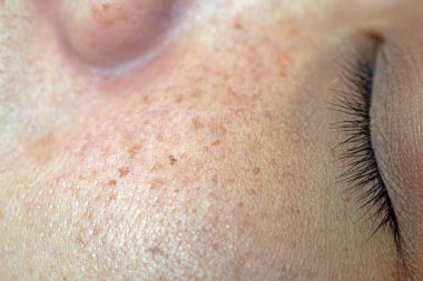 Kadınların sorunlu cilt gözenekleri ve yüzündeki siyah noktalar.