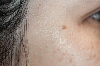 Kadınların sorunlu cilt gözenekleri ve yüzündeki siyah noktalar.