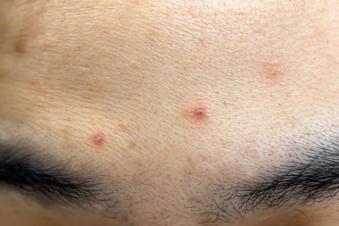 Asyalı Kadın Yüzü Yüzündeki Çiller, Cilt Sorunları