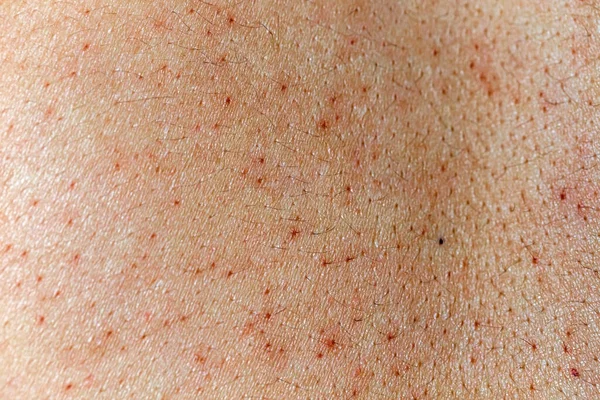 Poro Pele Problemático Mulher Manchas Escuras Rosto — Fotografia de Stock