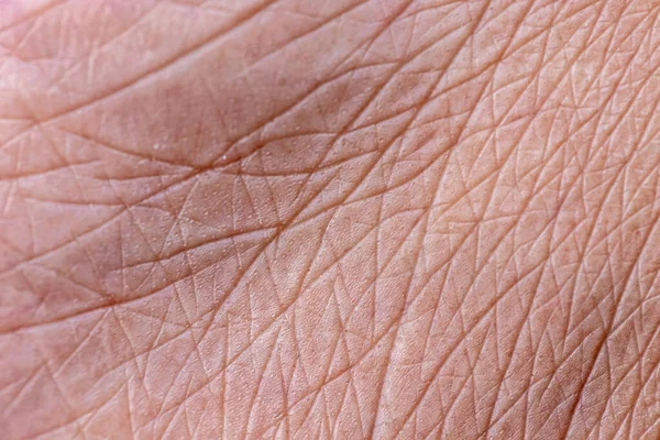 Closeup View Feet Dry Skin Cracks Heel — Stock Photo, Image