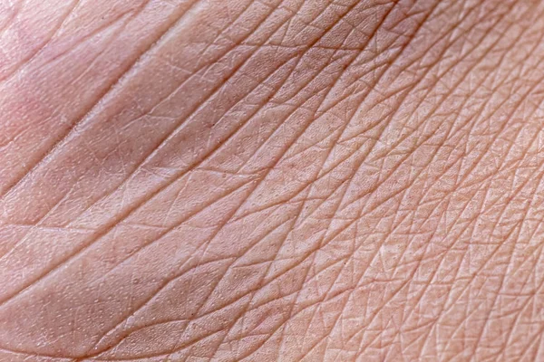 Closeup View Feet Dry Skin Cracks Heel — Stock Photo, Image