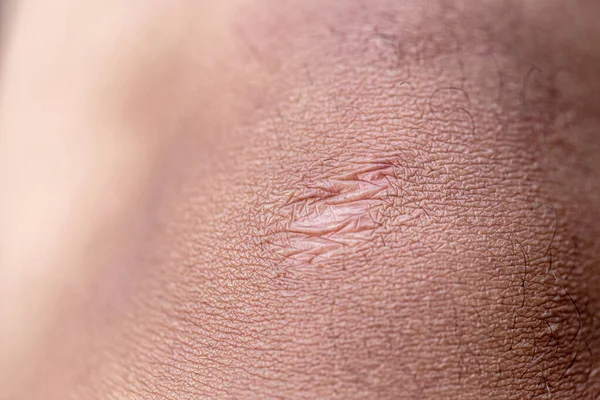 Close Cicatriz Queloide Cianótica Causada Por Cirurgia Sutura — Fotografia de Stock
