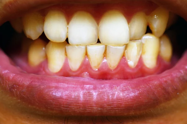 Špinavých zubů — Stock fotografie