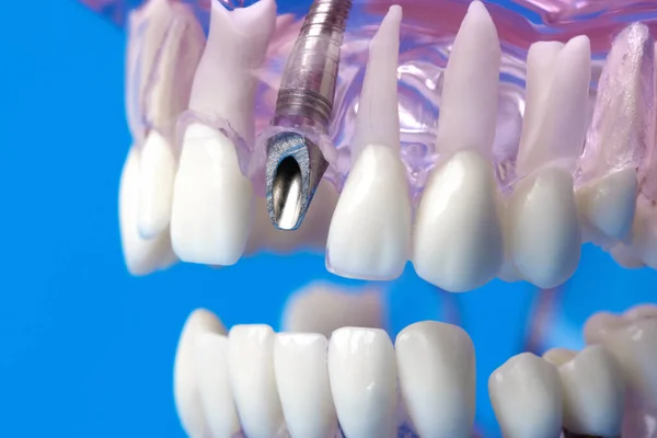 Zubní Implantát Šroub Modelu Lidské Čelisti Zuby — Stock fotografie
