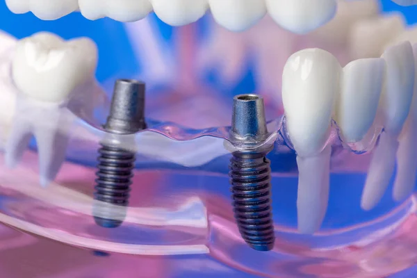 Zubní Implantát Mostní Šrouby Modelu Lidské Čelisti Zuby — Stock fotografie