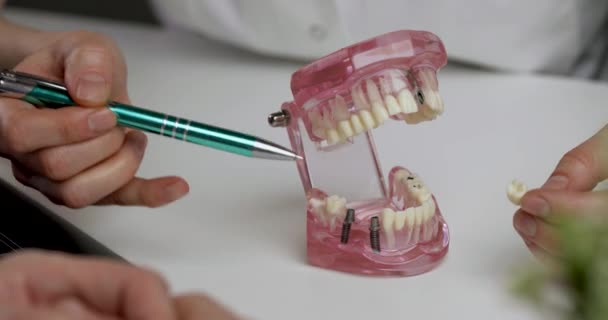 Імплантолог Показує Технологію Імплантації Зубів Моделі Щелепи Пацієнту — стокове відео