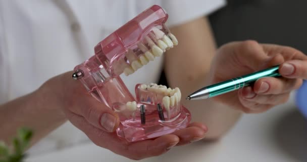 Odontología Implantología Implantólogo Dentista Con Modelo Mandíbula Dientes Humanos Mano — Vídeo de stock
