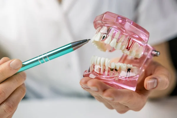 Dentist Implantologist Showing Dental Implant Technology Human Tooth Jaw Model — ストック写真