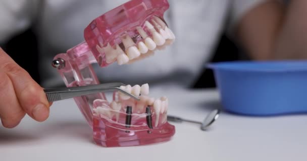 ヒトの歯顎モデルに歯科ブリッジインプラント技術を示す歯科インプラント学者 閉鎖だ — ストック動画