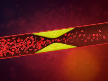 3d rendering atherosclerosis with cholesterol blood or plaque in vessel cause of coronary artery disease  clipart