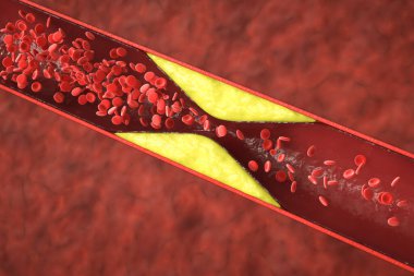Koroner arter hastalığına bağlı kolesterollü atheroskleroz ya da plaklı damar. 