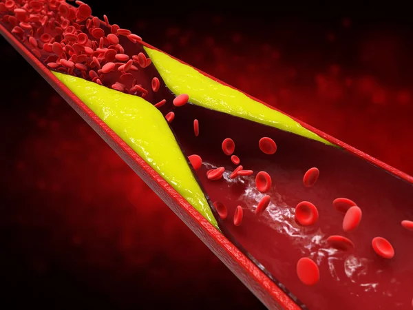 Rendering Atherosclerosis Cholesterol Blood Plaque Vessel Cause Coronary Artery Disease — Stock Photo, Image