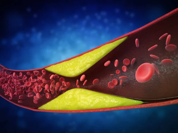 冠心病血管内带胆固醇血或斑块的动脉粥样硬化3D表现 — 图库照片