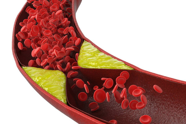 3d rendering atherosclerosis with cholesterol blood or plaque in vessel cause of coronary artery disease 
