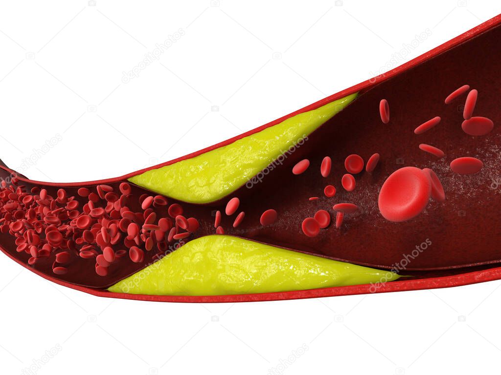 3d rendering atherosclerosis with cholesterol blood or plaque in vessel cause of coronary artery disease 