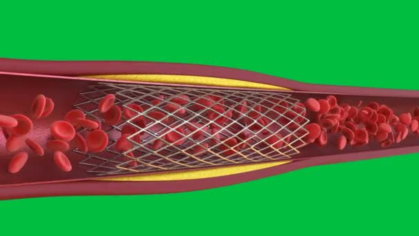 3Dレンダリングバルーン血管形成手順と静脈に隔離された緑の画面4K映像 — ストック動画