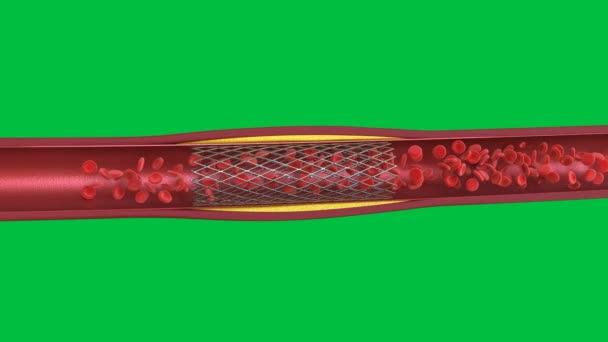 3Dレンダリングバルーン血管形成手順と静脈に隔離された緑の画面4K映像 — ストック動画