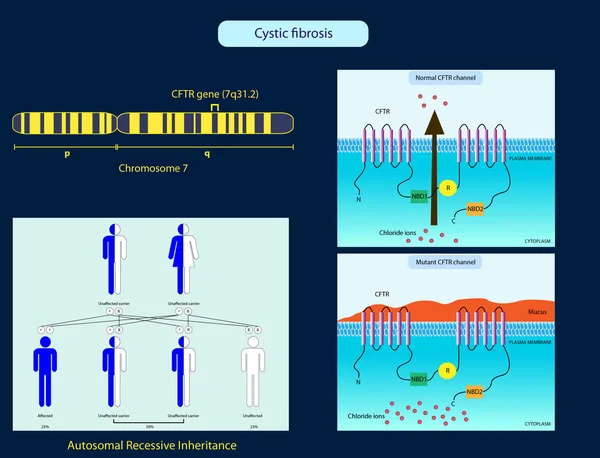 Cystic Fibrosis — Stockfoto