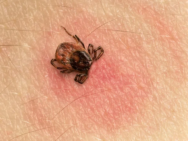 Tick bite — Stock Photo, Image