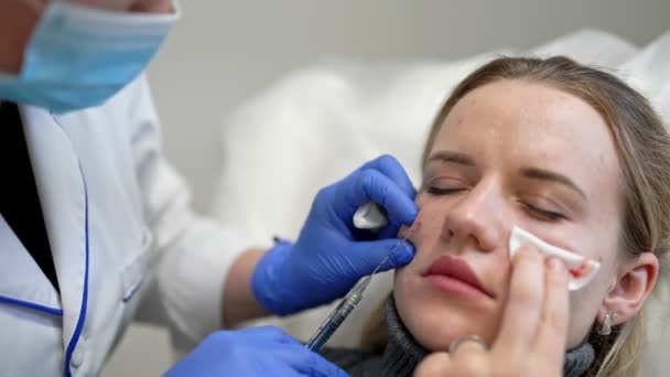 Frau bekommt kosmetische Botox-Injektion in Augennähe, Nahaufnahme. Frau im Schönheitssalon. Klinik für plastische Chirurgie — Stockvideo