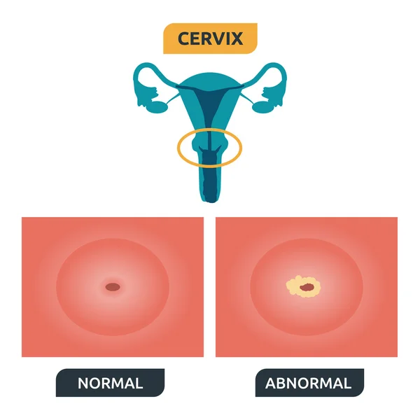 Cérvix — Vector de stock