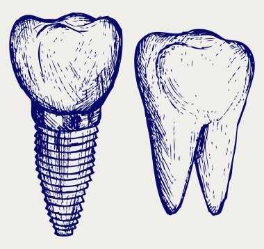 Ve molar diş implantı