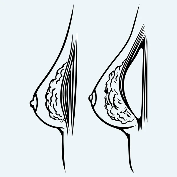 整形手術。乳房インプラント — ストックベクタ