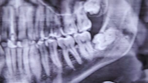 Dental Patient Female Xray Smile — Stock Video