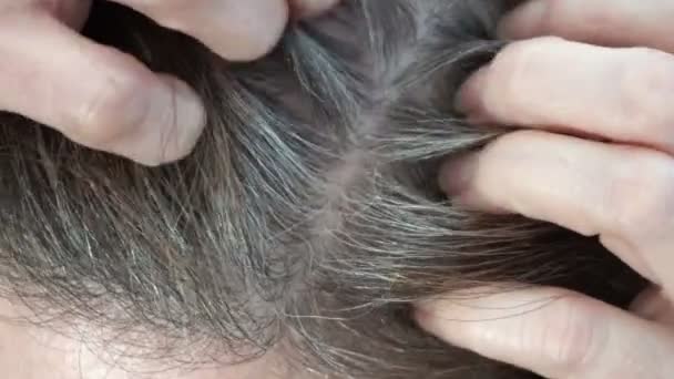 Closeup Shot Middle Aged Woman Itching Her Scalp Part Her — Stock Video