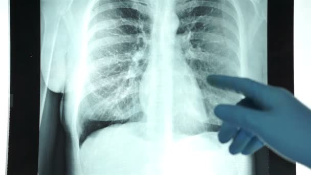 Health Care Doctor Pointing at a Chest X-ray — Stock Video