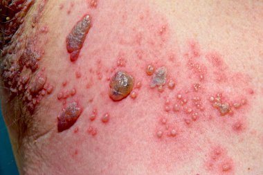 Shingles Infection Pustule Stage clipart