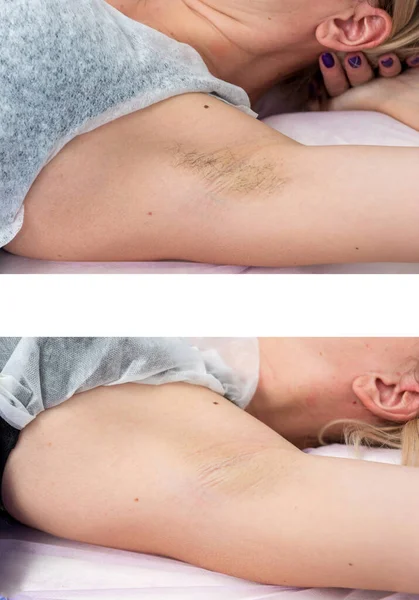 Zona de depilación axilas. Antes y después. Cera láser y azucarado — Foto de Stock