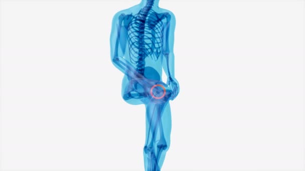 Lutut Keseleo Atau Sakit Menyebabkan Rasa Sakit Ilustrasi — Stok Video