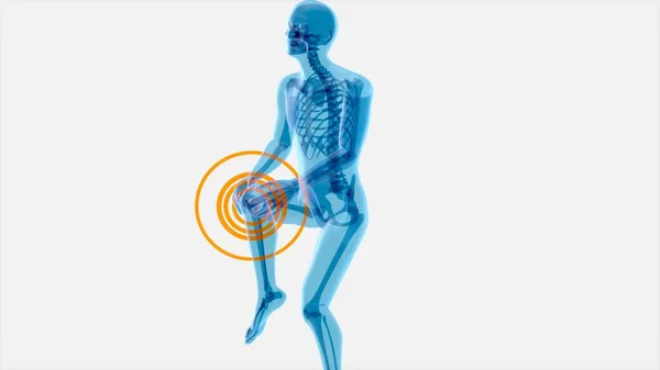 膝关节疼痛的抽象艺术 — 图库照片