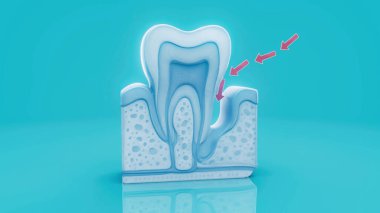 İnsan periodontitinin kavramsal modeli.