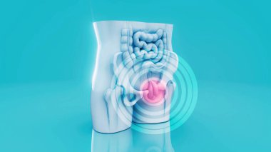 İnsan fıtığının kavramsal 3 boyutlu çizimi