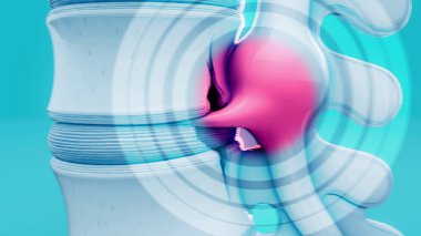 Belkemiğindeki fıtıklaşmış bir diskin kavramsal 3 boyutlu çizimi