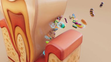 Diş etlerinin altındaki bakterili periodontitin kavramsal 3 boyutlu çizimi