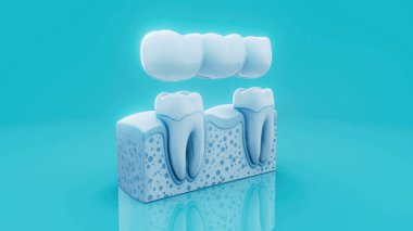 Mavi arkaplanda bir diş köprüsünün kavramsal 3D çizimi