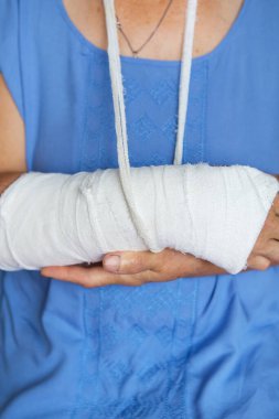 Alçılı ve bandajlı son sınıf öğrencisi bir kadın. Darbe, kırık, kemik, hastane
