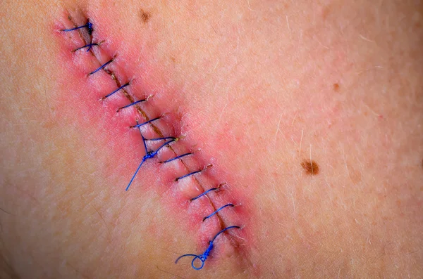 Stitched up wound after mole removal surgery. Stock Image