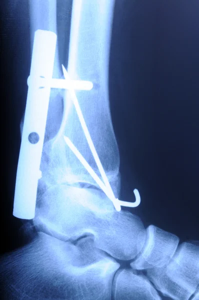 Insan kırık ayak bileği grafisi — Stok fotoğraf