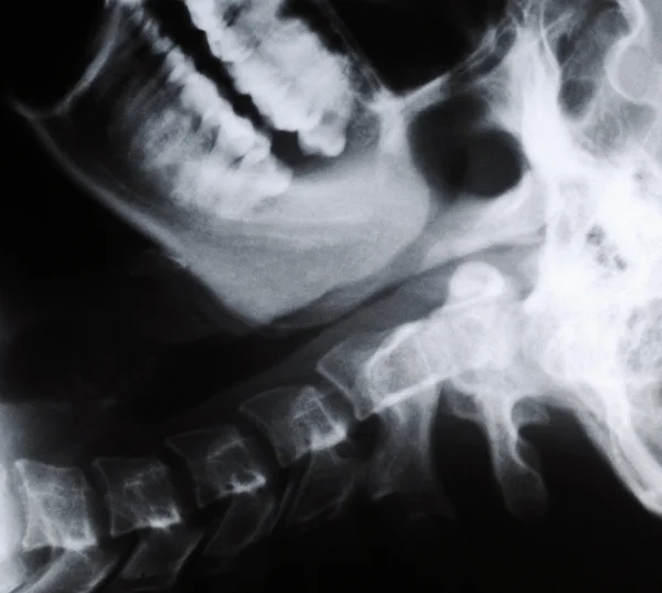 Radiograph of human neck — Stock Photo, Image