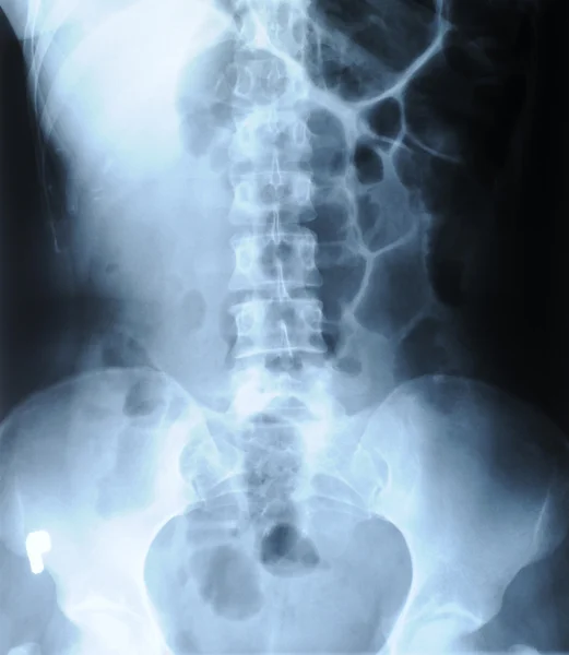 Radiograph of human backbone — Stock Photo, Image